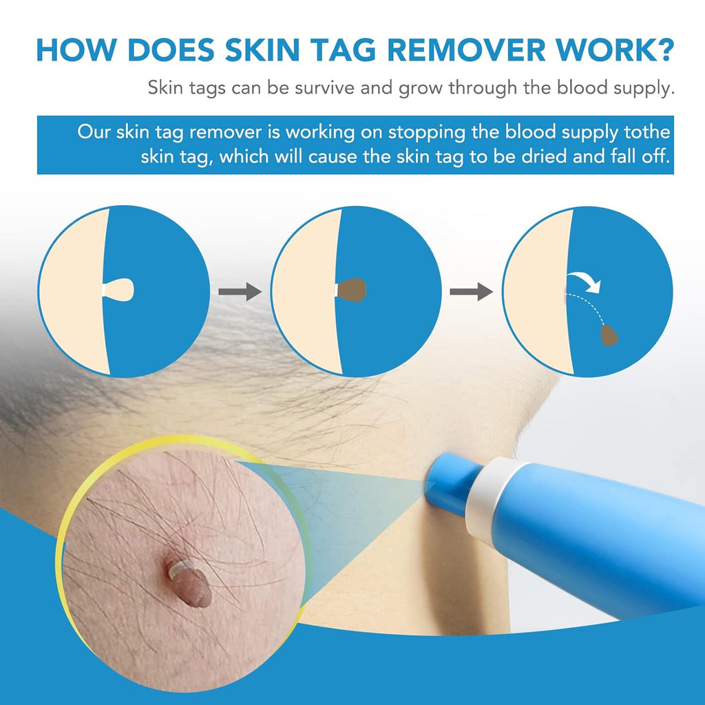 Person using the skin tag remover applicator on their arm.