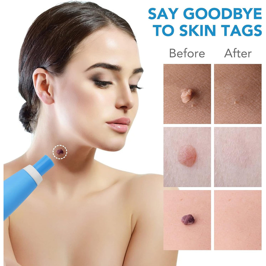 Infographic showing skin tag sizes from 2mm to 8mm