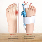 Close-up of PP bracket for toe correction